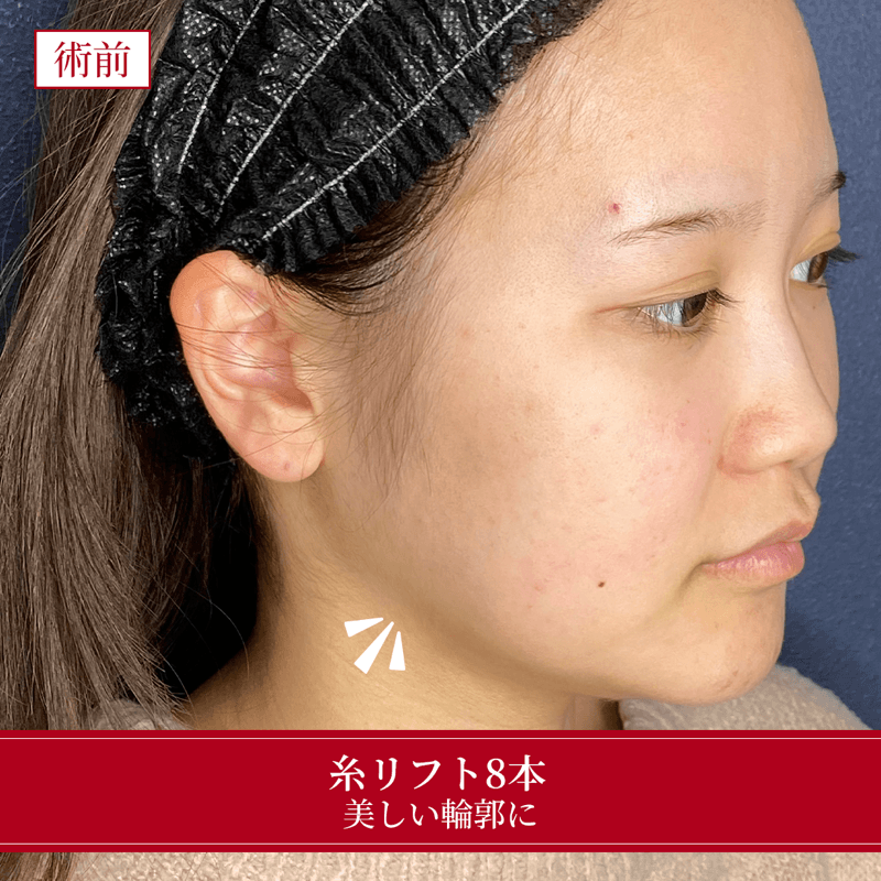施術前