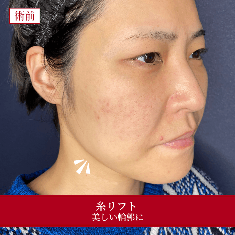 施術前